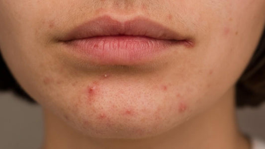 Perioral Dermatitis - What You Can Do!